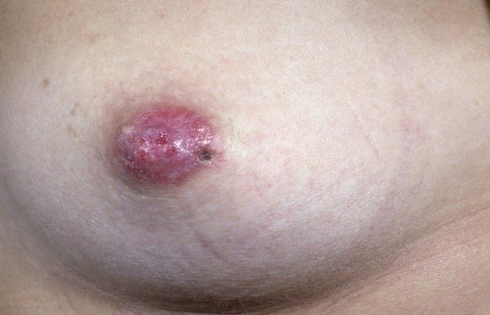 مرض باجيت في الثدي Paget’s disease of the breast