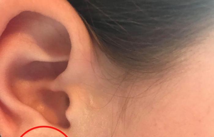كيف نعالج التهاب ثقب الأذن ؟